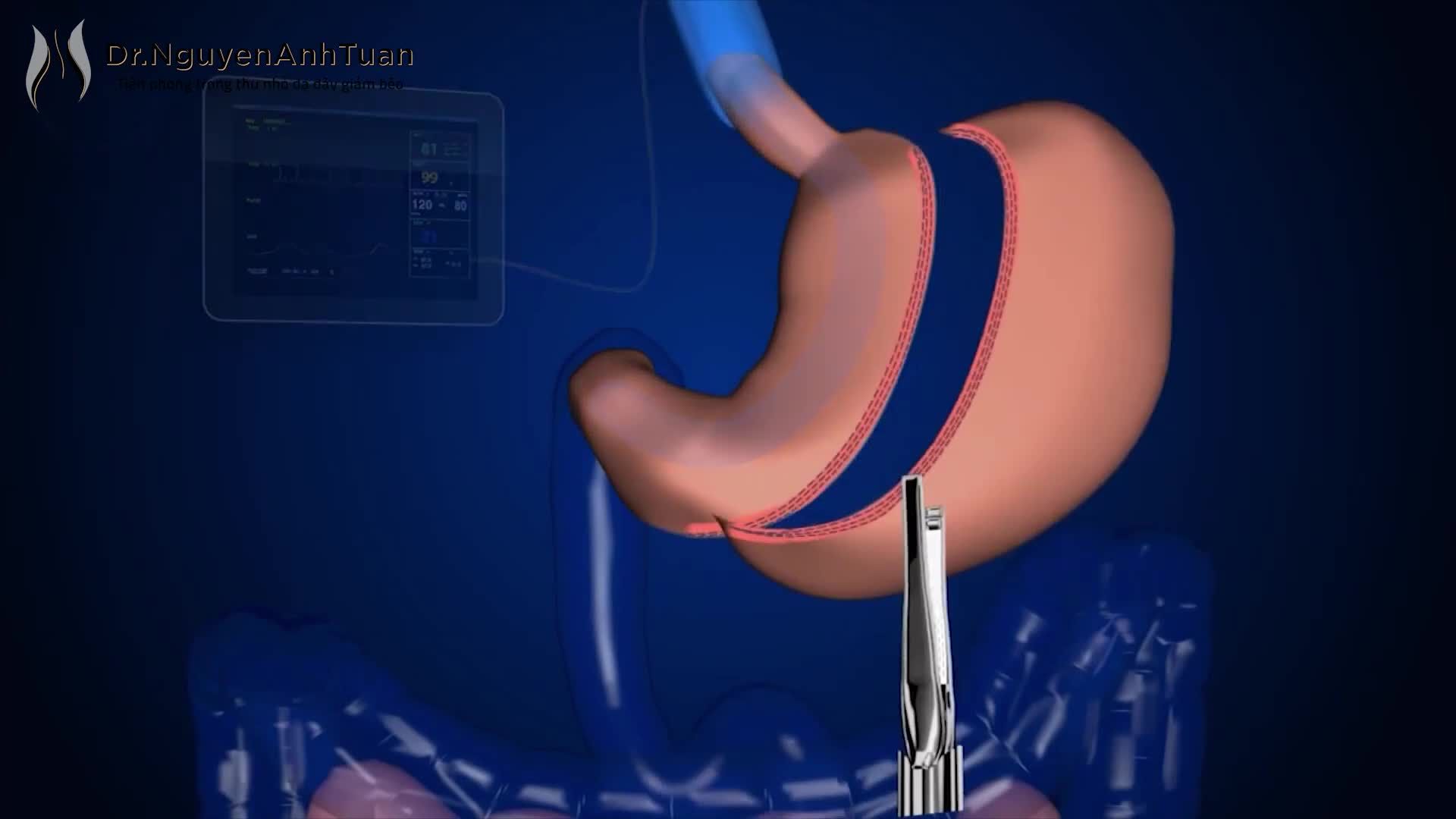Các bạn có thắc mắc phẫu thuật nội soi thu nhỏ dạ dày giảm béo là như thế nào và hiệu quả ra sao không Video ngắn dưới đây sẽ cho bạn câu trả lời.