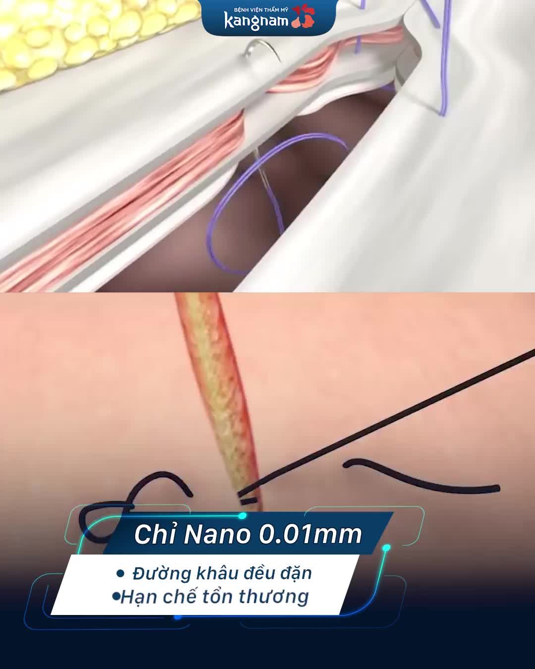 Cắt mí 6D có gì vượt trội so với công nghệ cũ