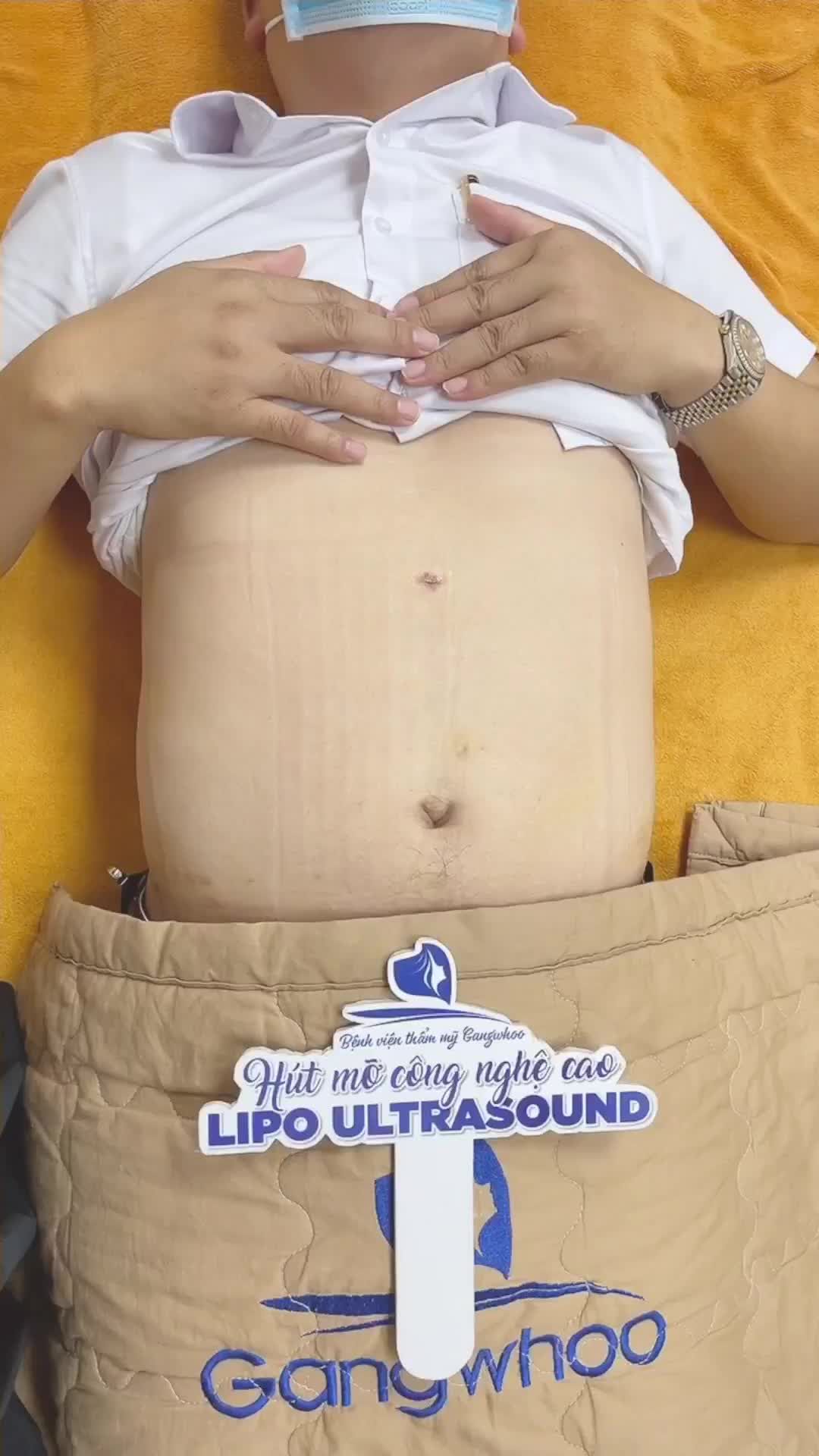 LIPO ULTRASOUND TUNG THẦN CHƯỞNG GIẢI QUYẾT GỌN BỤNG BIA CHO ANH KHÁCH QUẬN 2