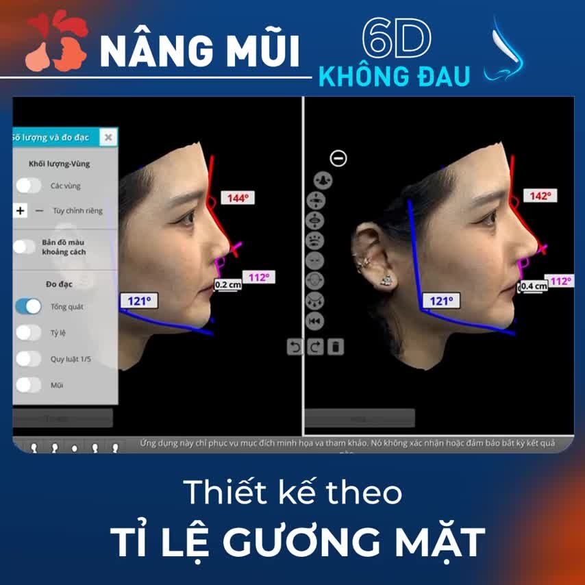 Nâng mũi 6D không đau - Thiết kế mũi đẹp chuẩn tỉ lệ