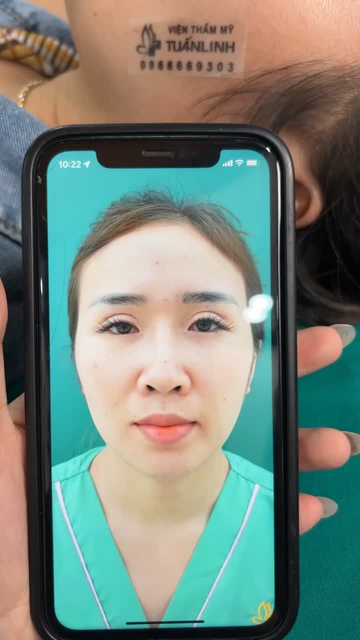 Tái khám, cắt chỉ sau 10 ngày nâng mũi cấu trúc sửa lại sụn Surgiform