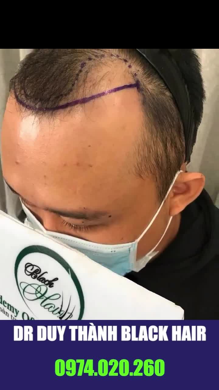 Cấy tóc nam điều trị hói đầu chữ M