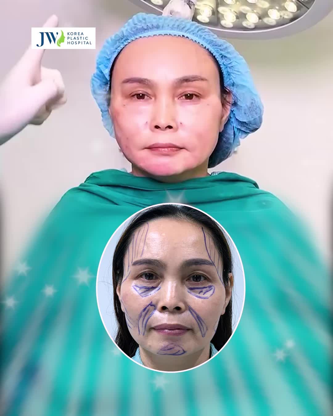 SỬNG SỐT quý cô Cải lão gương mặt 3M Cấy mỡ mặt TRẺ MĂNG như GÁI ĐÔI MƯƠI, không nói không biết U50