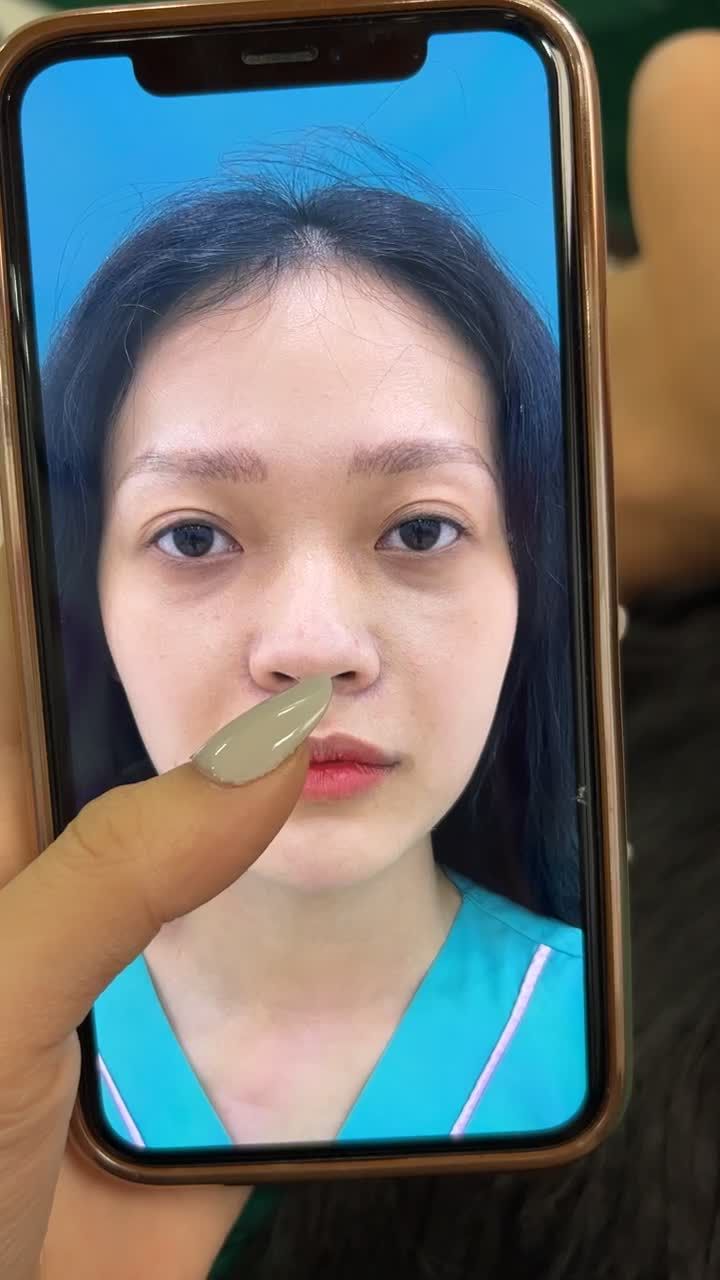 Cận cảnh dáng mũi sau 10 ngày tái khám