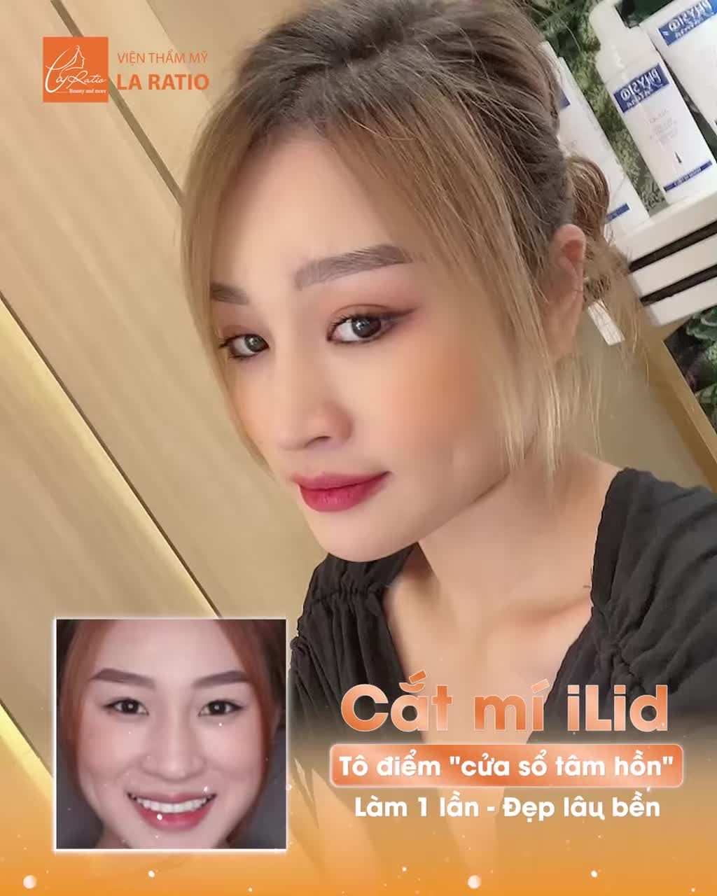 Cắt mí iLid - Giải pháp toàn diện cho đôi mắt