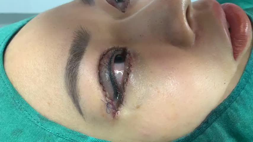 Cắt mí trên , mí dưới cho bạn gái SG ra HN