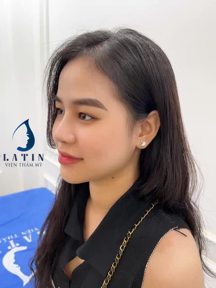 Tái khám mũi bán cấu trúc đẹp chuẩn chỉnh của khách hàng Latin sau 2 tháng.