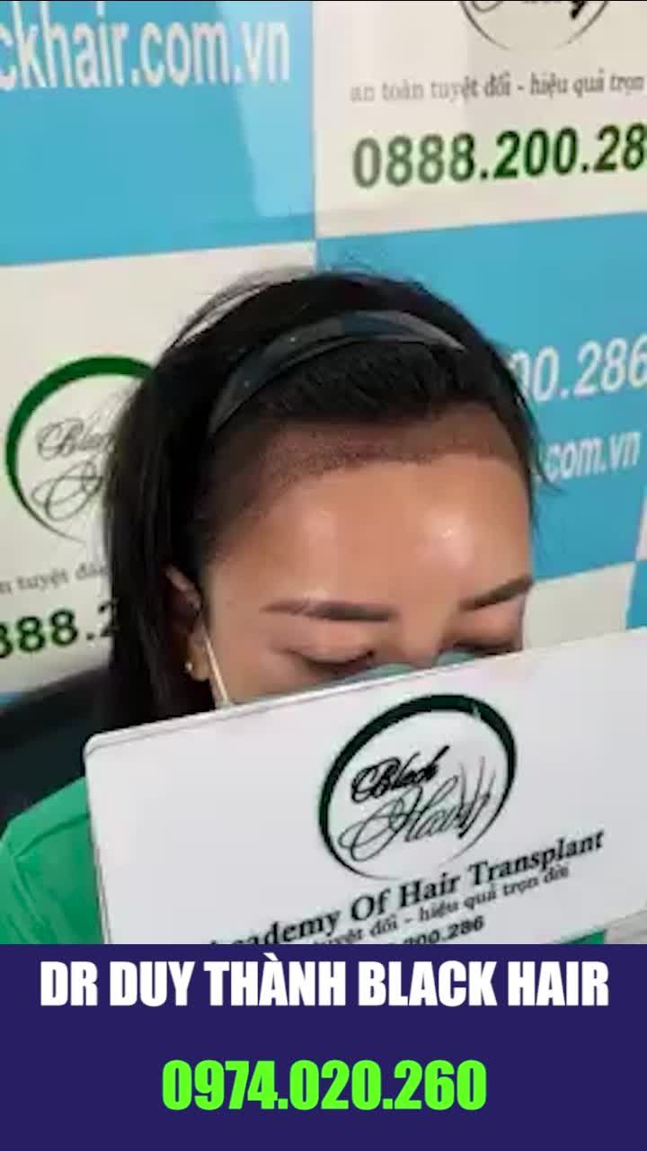 Cấy tóc hạ thấp đường chân tóc cho bạn nữ xinh đẹp