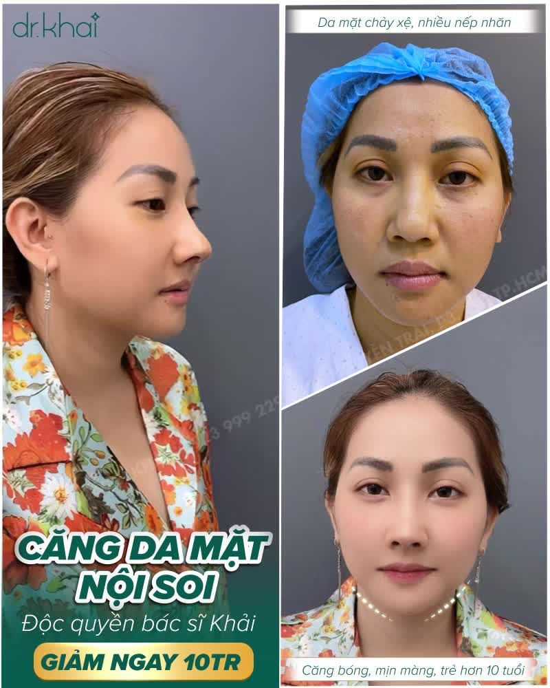 CĂNG DA MẶT NỘI SOI - 5 KHÔNG