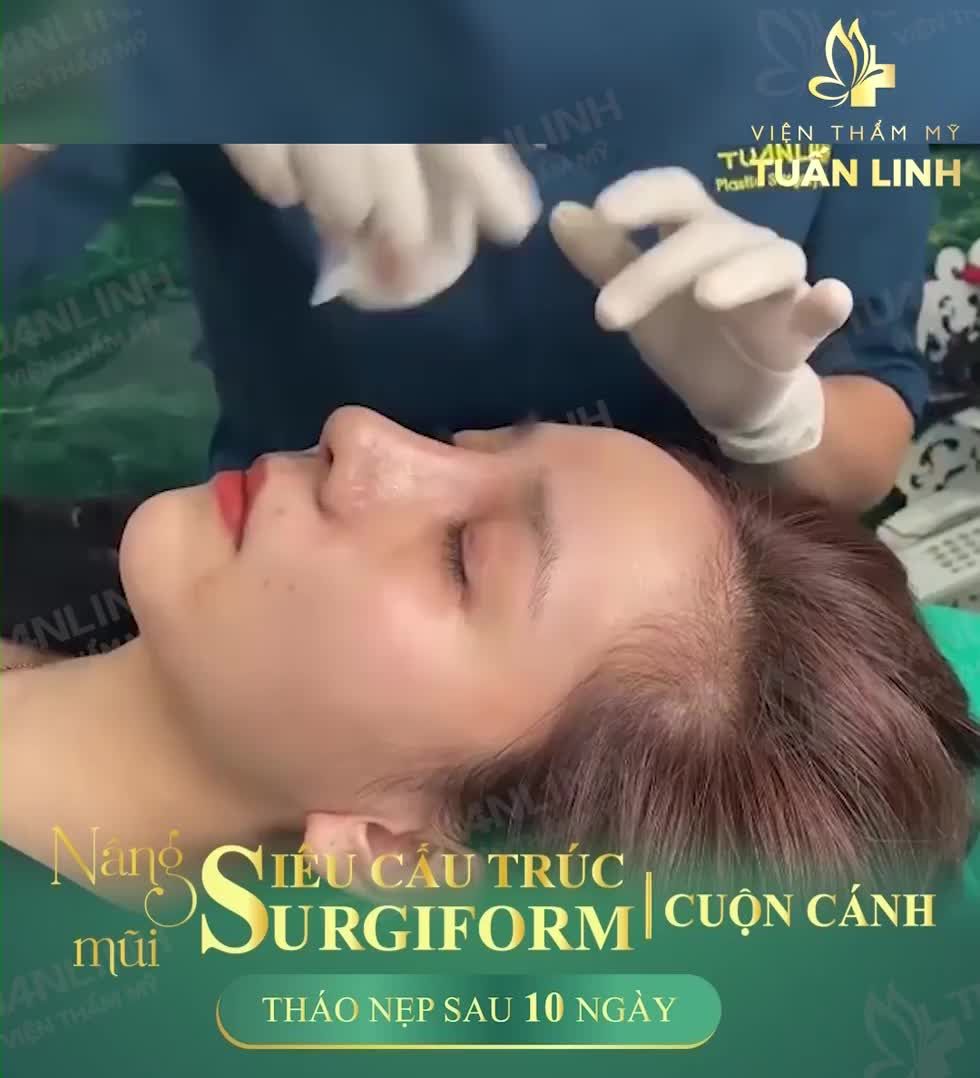DÁNG MŨI SAU 10 NGÀY NÂNG SIÊU CẤU TRÚC SURGIFORM