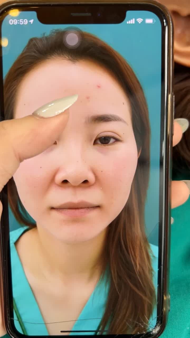Đã từng nâng mũi trước đây nhưng mũi bị lệch, đầu mũi to và rộng, chị chọn sửa lại mũi tại Tuấn Linh