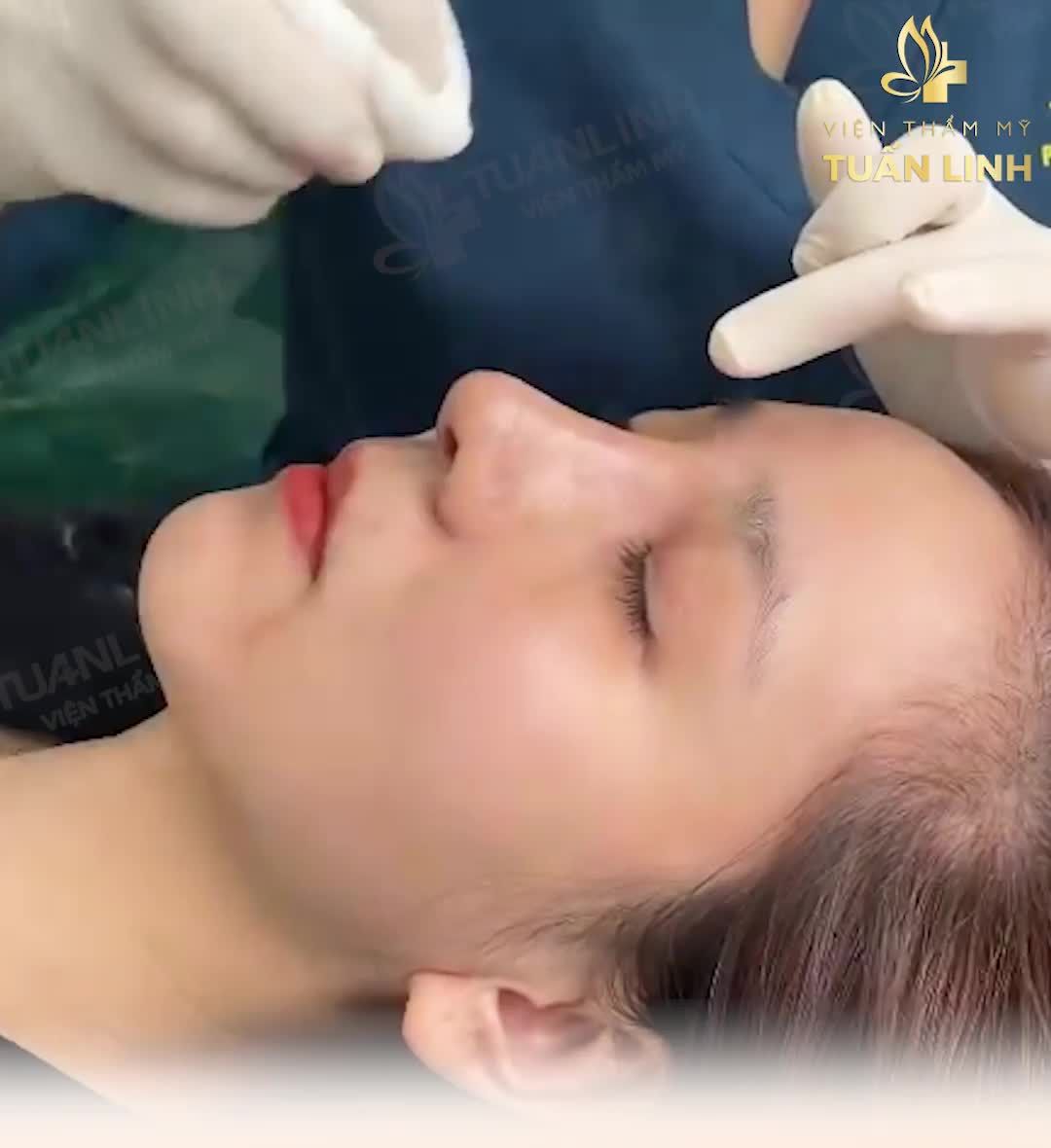 Tại sao sụn Surgiform luôn được bác sĩ khuyên dùng trong thẩm mỹ nâng mũi