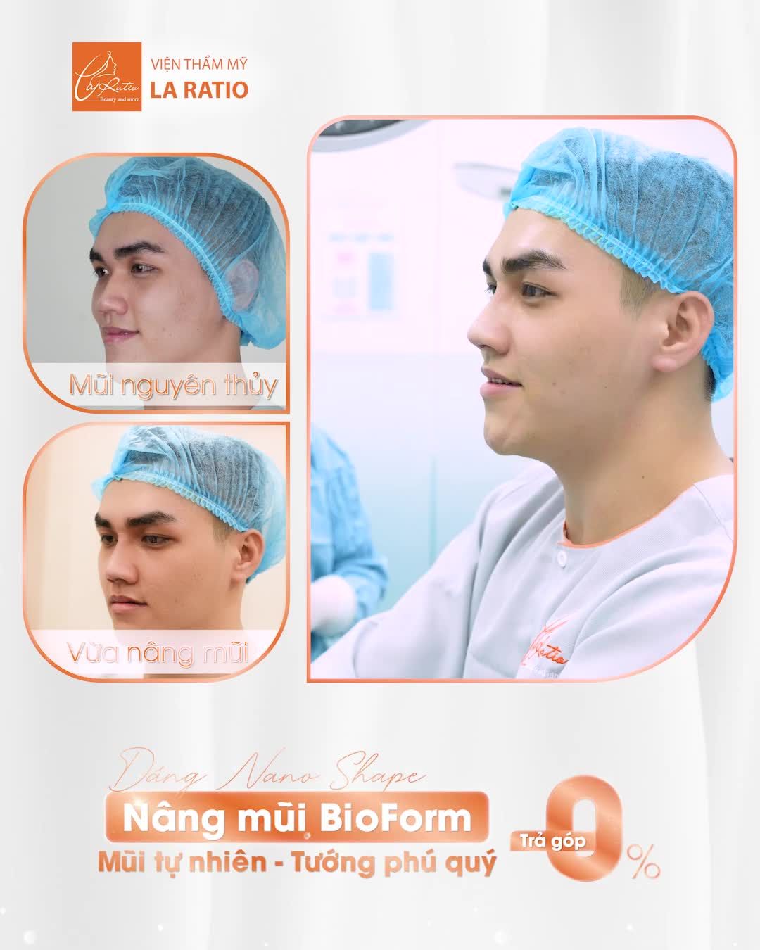 DÁNG MŨI ĐẸP KHÁC BIỆT HOÀN TOÀN SAU 45 PHÚT NÂNG MŨI BIOFORM NAM