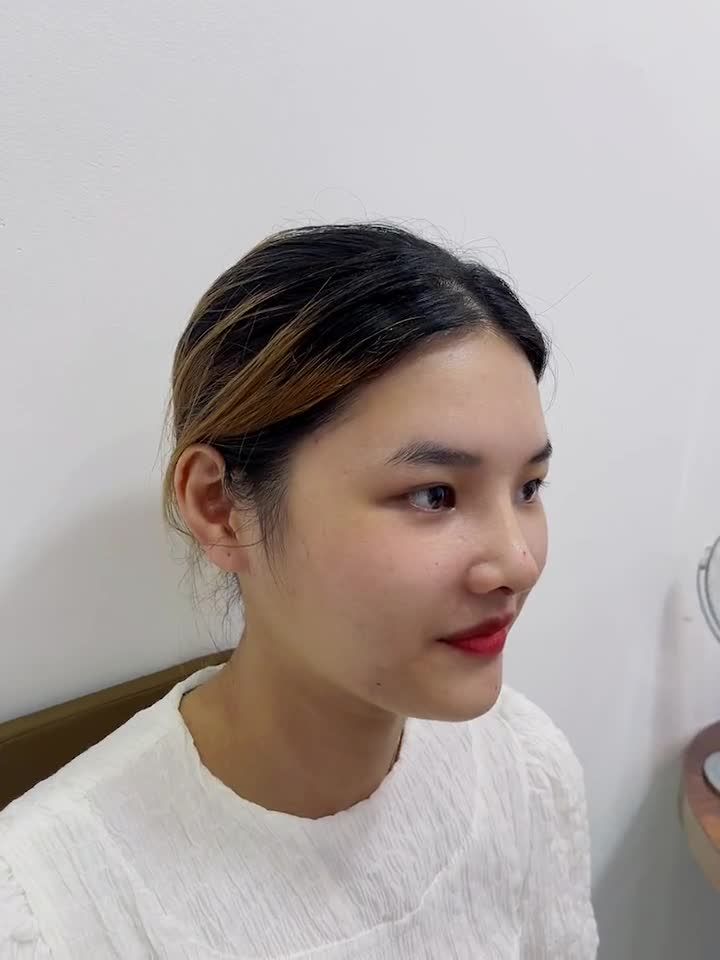 Kết quả nâng mũi 6D không đau hút mắt nhìn tại BVTM Kangnam Sài Gòn  Xem ngay!!!