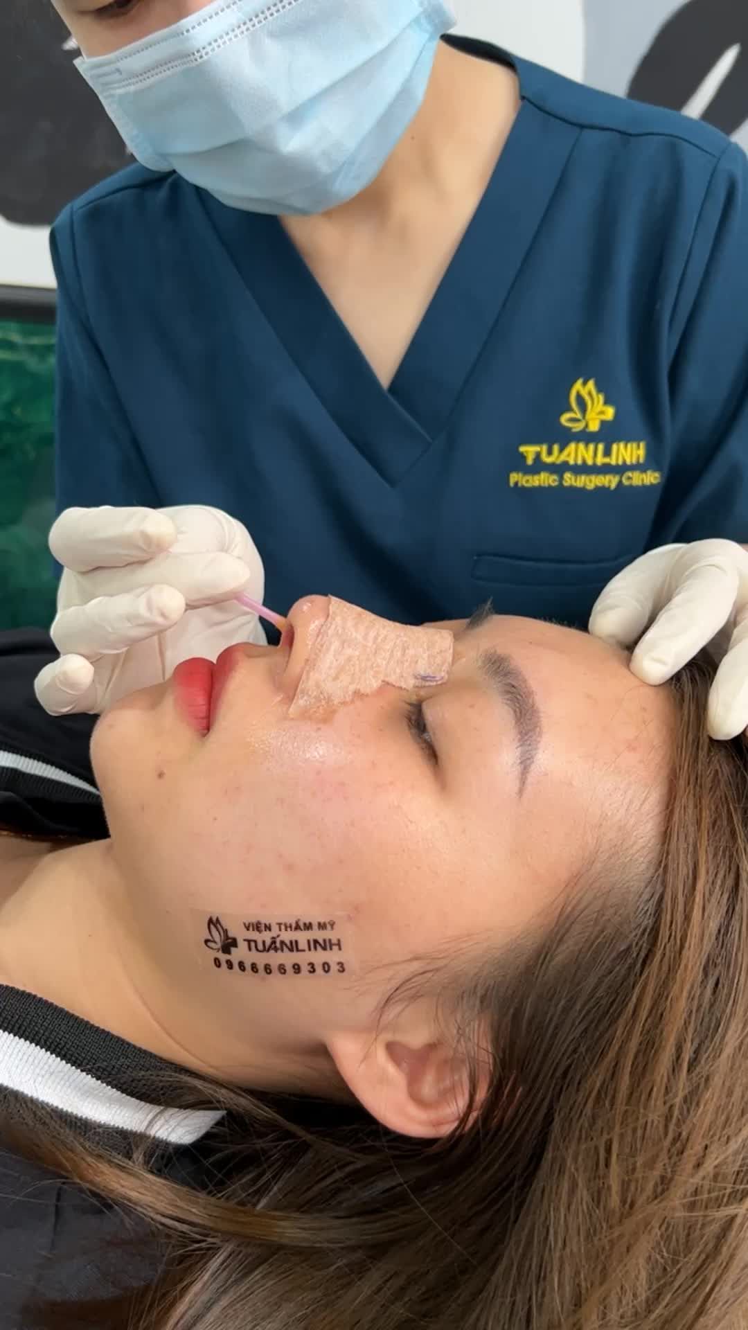 Khắc phục hoàn toàn tình trạng mũi thấp tẹt, ngắn hếch chỉ sau 10 ngày nâng mũi cấu trúc.