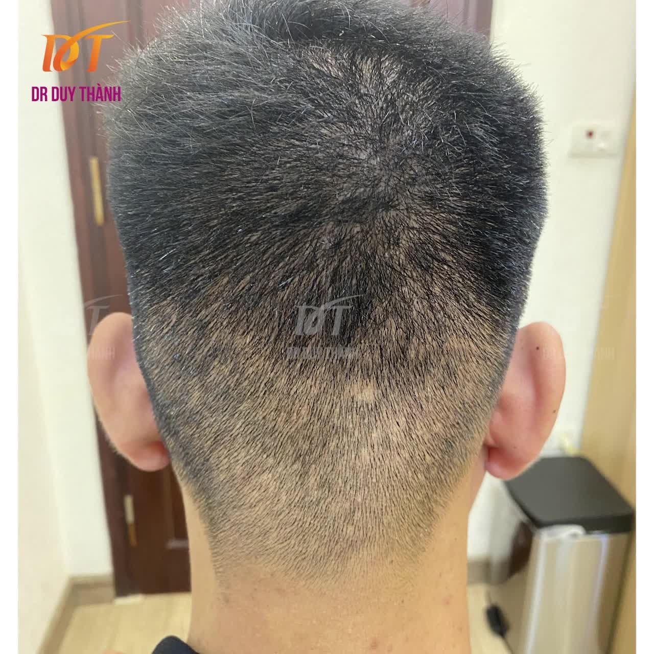 Ngồi chờ lên máy bay, cảm xúc ùa về, N. nghĩ về lần cấy tóc thất bại từng trải ở một cơ sở khác vừa hư tóc vừa mất tiền, lại còn đau nữa.