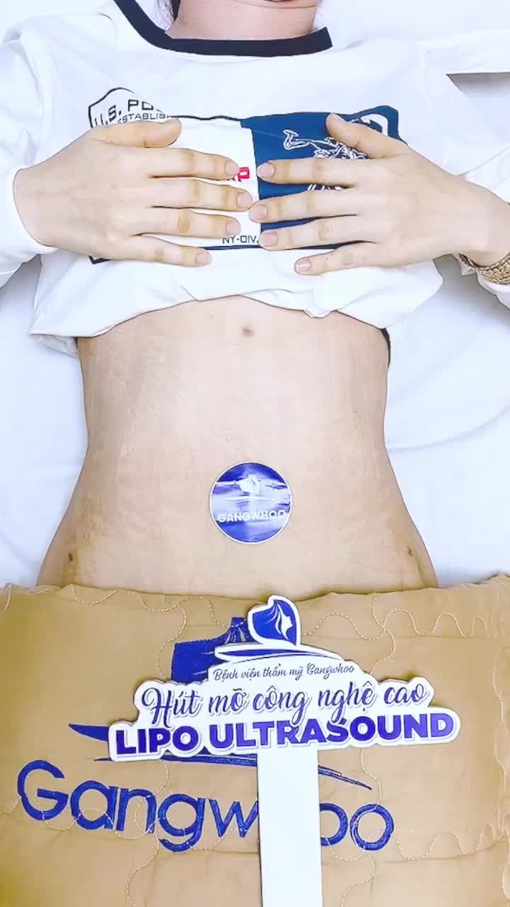 Tái khám 1 tháng cho chị khách hàng tin tưởng và lựa chọn dịch vụ hút mỡ công nghệ cao Lipo Ultrasound