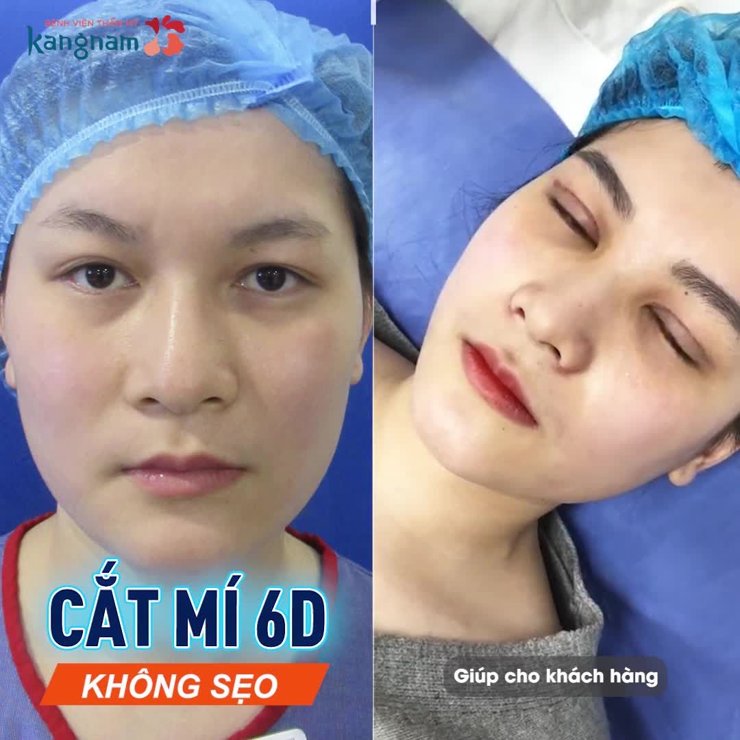 Quy trình cắt chỉ CẮT MÍ 6D