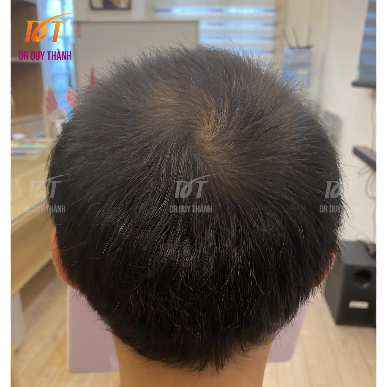 Lên video cấy 2000 nang tóc lấy lại phong độ cho bạn nam 30 tuổi điển trai, lịch lãm tới từ Nha Trang.