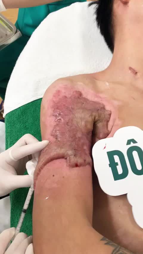 SẸO LỒI siêu to khổng lồ do BỎNG HÓA CHẤT!!!