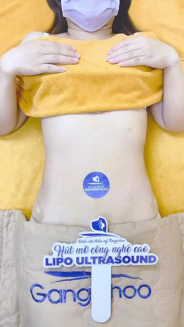 Tái khám sau 7 ngày cho chị Việt Kiều Đài Loan thực nguyên combo hút mỡ công nghệ cao Lipo Ultrasound toàn thân