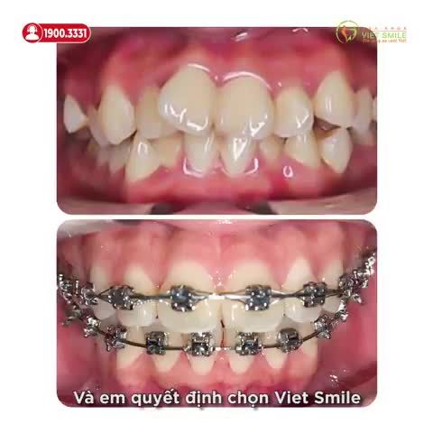CẢM NHẬN SAU 1 NĂM NIỀNG RĂNG KHẤP KHỂNH