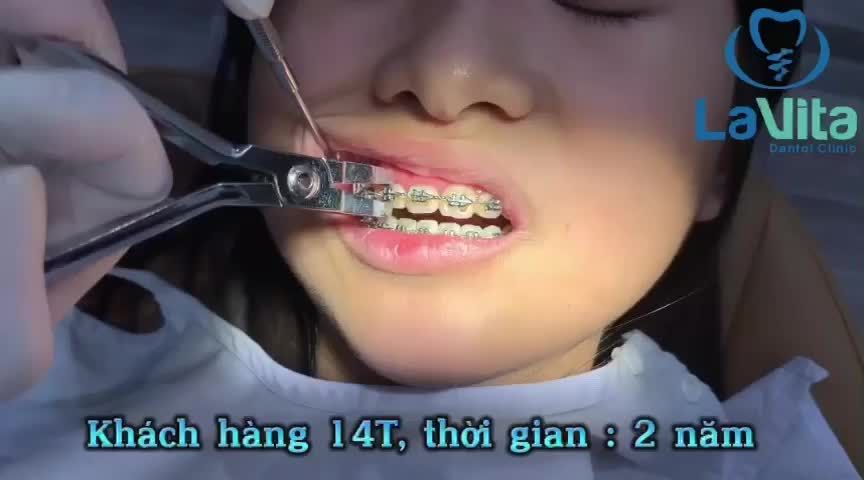 Case chỉnh nha trong 2 năm của bạn gái 14 tuổi - Chỉ 24 tháng để có được thành quả vô cùng xứng đáng.