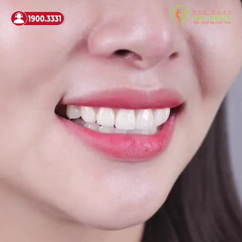DÁN SỨ VENEER KHẮC PHỤC TÌNH TRẠNG RĂNG CỬA BỊ MẺ