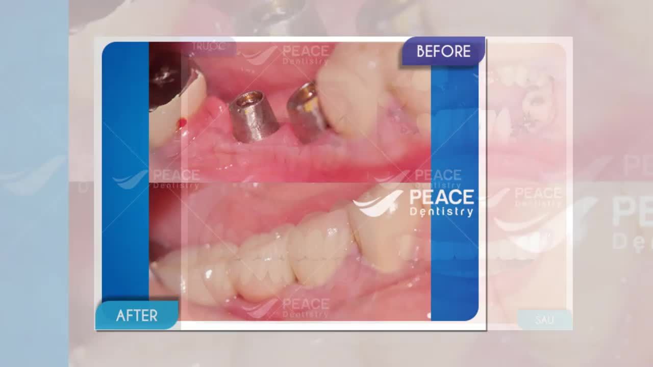 Giải pháp tối ưu cho người mất răng