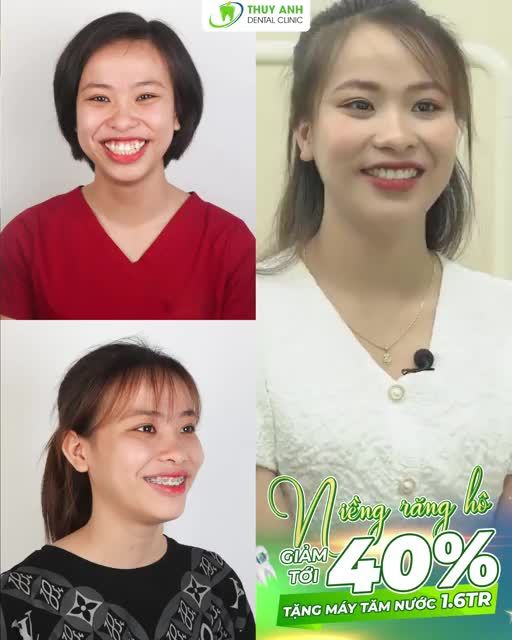 GÓI NIỀNG RĂNG CÁ NHÂN HÓA NHÂN ĐÔI HIỆU QUẢ