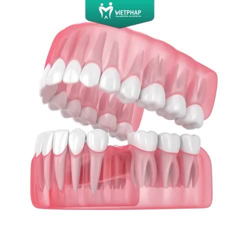 KHÓ TIN KHI VIỆC MẤT RĂNG LÂU NGÀY SẼ DẪN TỚI NHIỀU HẬU QUẢ ĐẾN VẬY