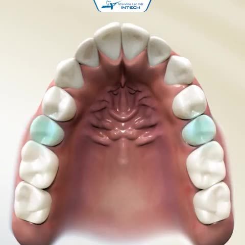 Không gắn band có niềng răng được không