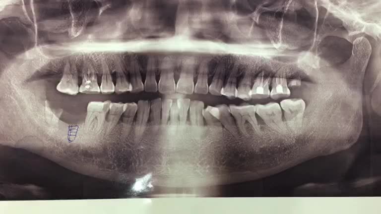 Lắp răng sứ cho răng implant số 47 hoàn thiện quá trình trồng răng của bác Thái tại Nha Khoa Thuỳ Anh