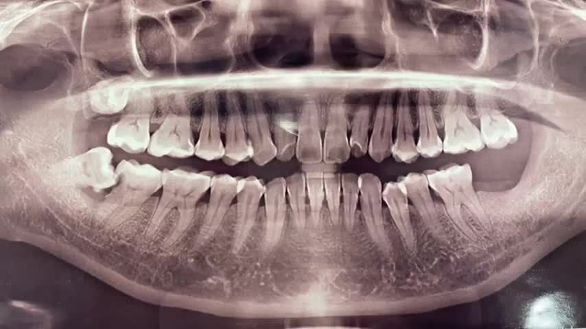 Lắp răng sứ sau cấy Implant cho chị Oanh tại Nha Khoa Thuỳ Anh