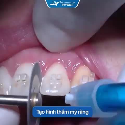 MÀI KẼ RĂNG LÀ GÌ MỤC ĐÍCH CỦA MÀI KẼ RĂNG TRONG CHỈNH NHA