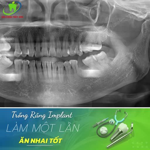 MẤT RĂNG PHẢI TRỒNG NGAY RĂNG IMPLANT THÔI!
