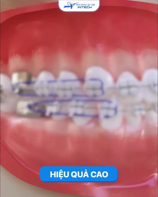 Niềng răng cá tính cùng mắc cài buộc chun