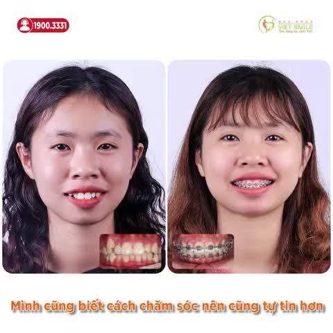 NIỀNG RĂNG GIẢM HÔ, CHEN CHÚC - RĂNG KHOẺ ĐẸP, NỤ CƯỜI TỰ TIN