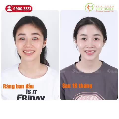 NIỀNG RĂNG KHAY TRONG SUỐT CẢI THIỆN CHEN CHÚC