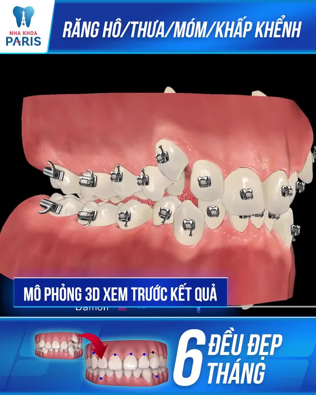 Niềng Răng Mắc Cài - Khó Mấy Cũng Đều
