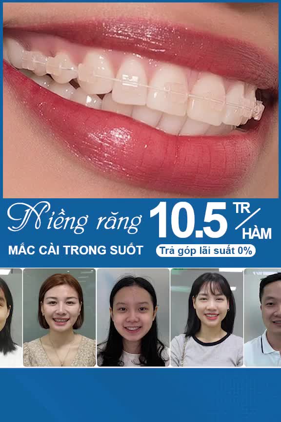 NIỀNG RĂNG TRONG SUỐT - BIẾT TRƯỚC KẾT QUẢ