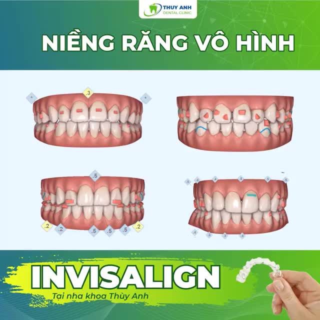 NIỀNG RĂNG VÔ HÌNH – PHƯƠNG PHÁP ĐƯỢC NHIỀU KHÁCH HÀNG LỰA CHỌN