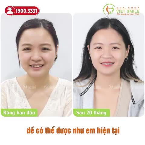 NỤ CƯỜI ĐẠT 90% SAU 20 THÁNG NIỀNG RĂNG CHEN CHÚC, KHỚP CẮN SÂU