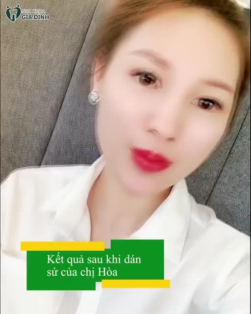 NỤ CƯỜI HÒA  ANNA THAY ĐỔI NHƯ THẾ NÀO SAU KHI THẨM MỸ RĂNG SỨ