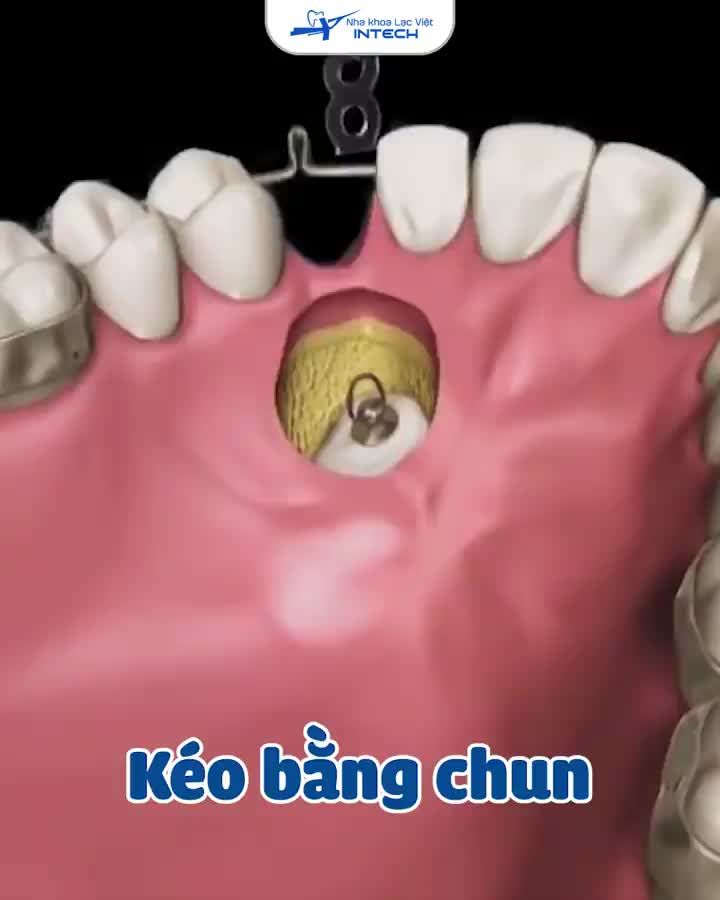 Quá trình kéo răng mọc ngầm được thực hiện như thế nào