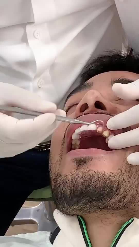 QUÁ TRÌNH LẮP RĂNG SỨ ORODENT CAO CẤP CHO SIÊU MẪU DANH NGỌC