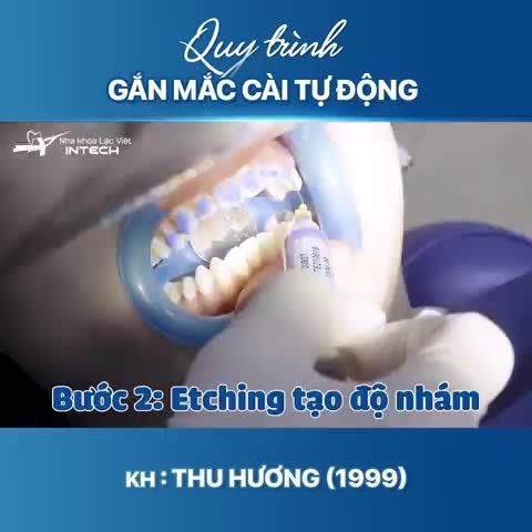 QUY TRÌNH GẮN MẮC CÀI TẠI NHA KHOA LẠC VIỆT INTECH