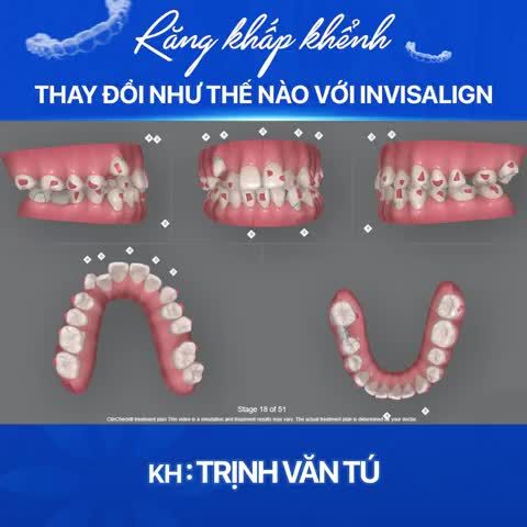 RĂNG KHẤP KHỂNH DỊCH CHUYỂN THẾ NÀO VỚI INVISALIGN