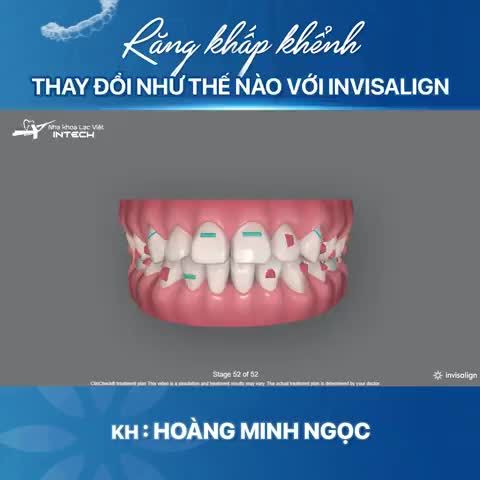 RĂNG KHẤP KHỂNH, HÔ THAY ĐỔI NHƯ THẾ NÀO KHI NIỀNG INVISALIGN