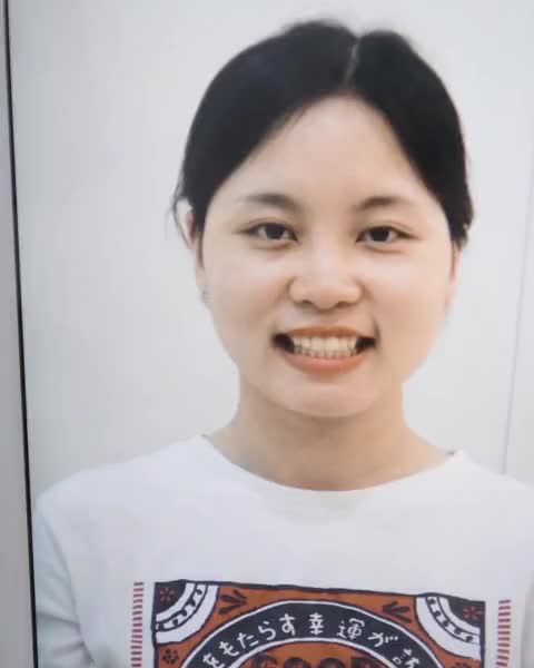 Tái khám sau tháo mắc cài - KH Lê Thị Kim Anh (1993)